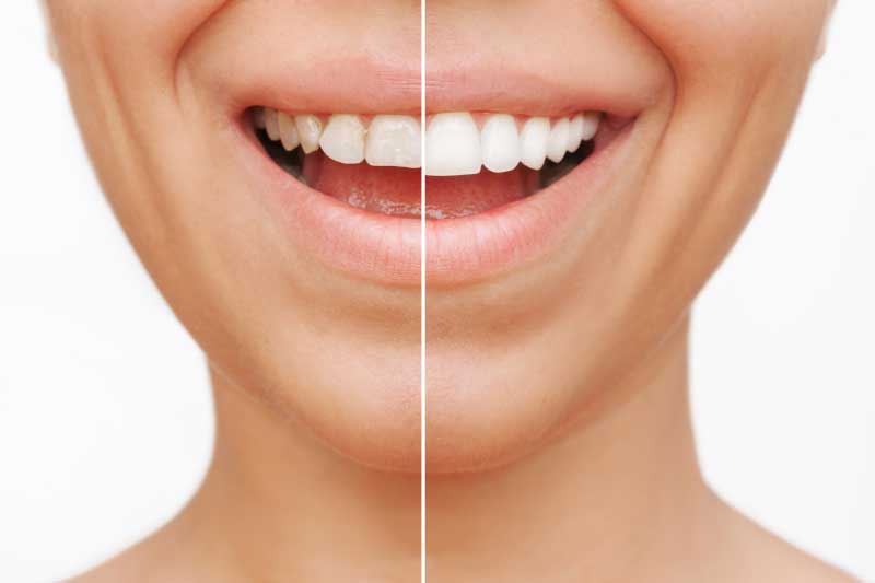 Comment choisir le meilleur traitement dentaire cosmétique