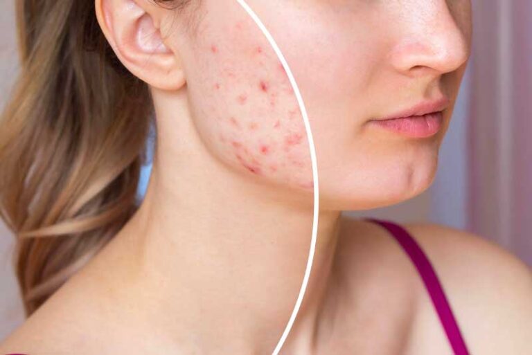 Le pouvoir des peelings chimiques : Transformer les cicatrices d’acné plus profondes pour une peau plus claire