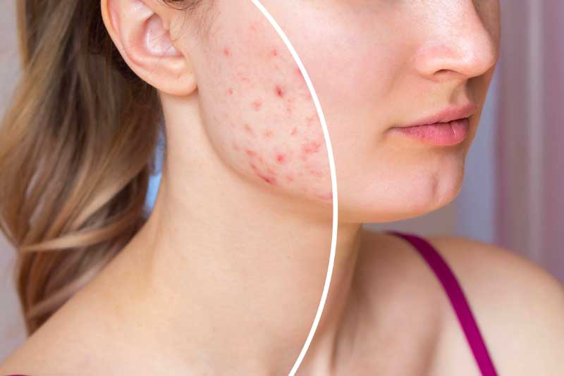 Transforming Deeper Acne Scars for Clearer Skin