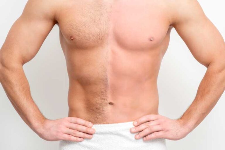 Top 9 des options d’épilation au laser pour les hommes : des résultats lisses et sans poils