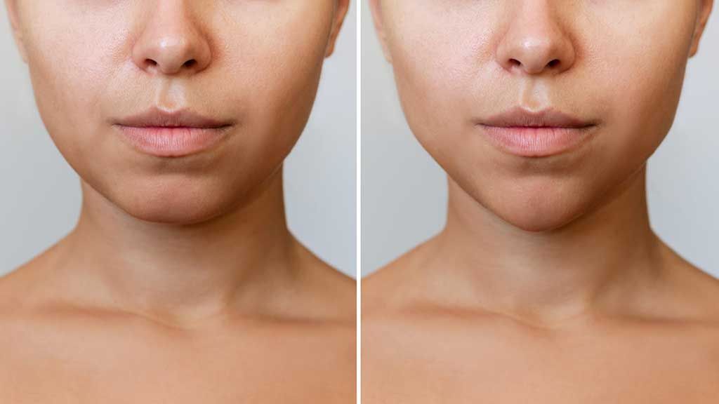 Recovery And Aftercare Tips For Your Chin Filler