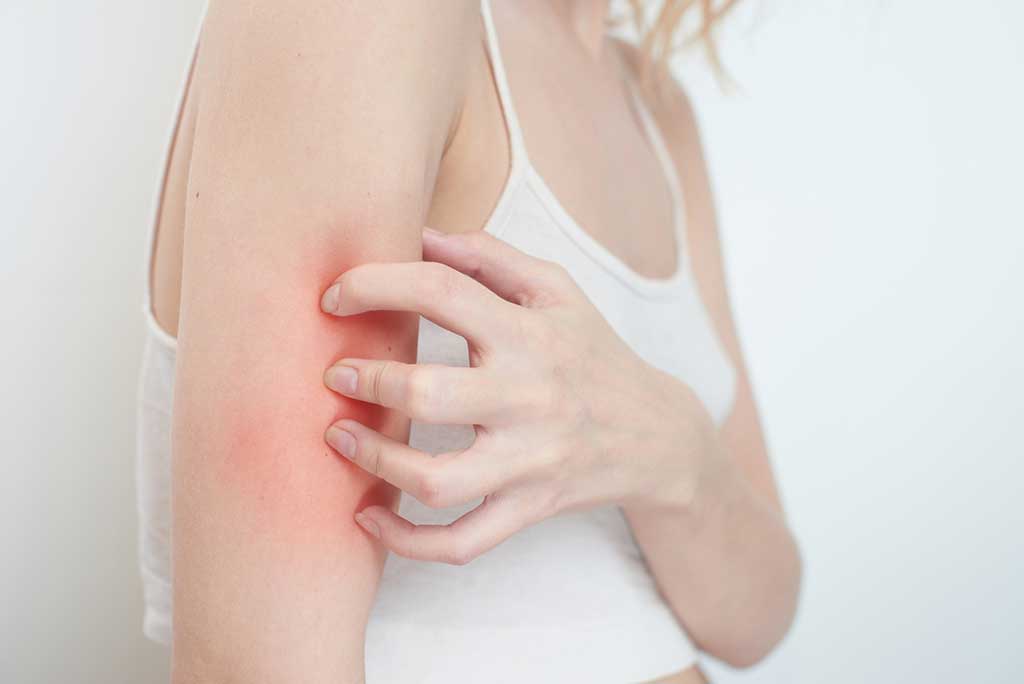 What Are Those Bumps on My Arms? A Rough Guide to KP