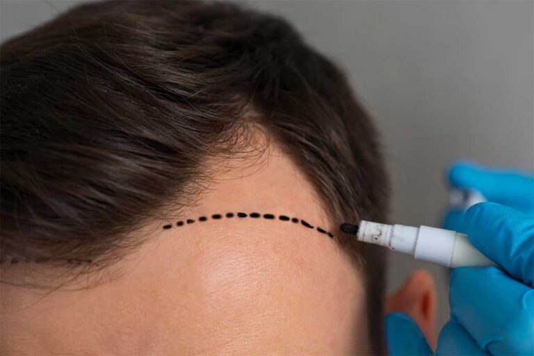 Micropigmentation du cuir chevelu : une solution de pointe pour les cheveux clairsemés